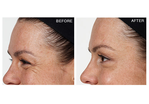 Anti-Wrinkle Injections – Crows Feet