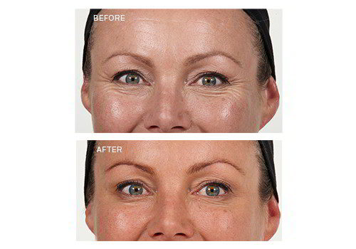 Anti-Wrinkle Injections – Crows Feet