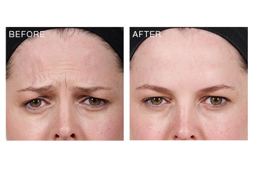 anti-wrinkle-injections-frown-lines-dr-eugene-green